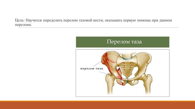 Цель: Научится определять перелом тазовой кости, оказывать первую помощь при данном переломе