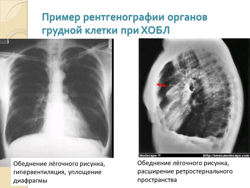 Пример рентгенографии органов грудной клетки при