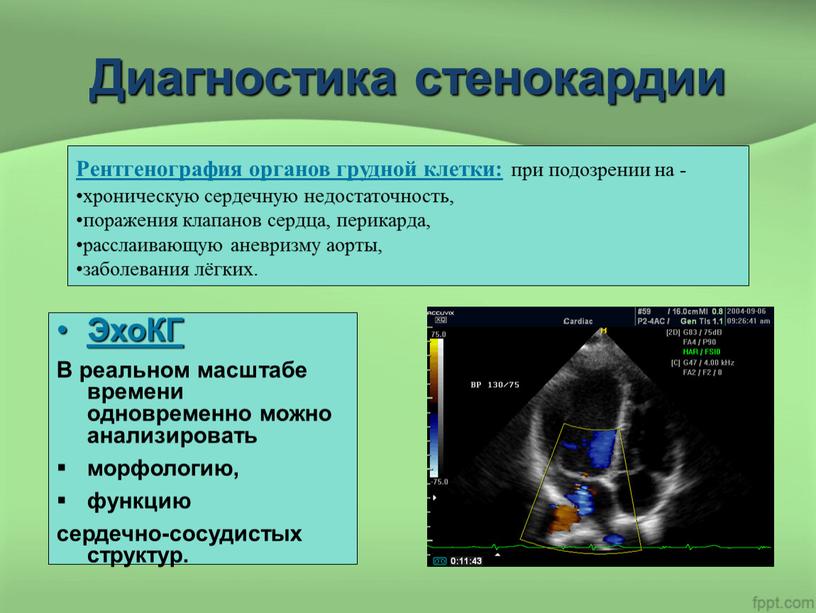 Диагностика стенокардии ЭхоКГ