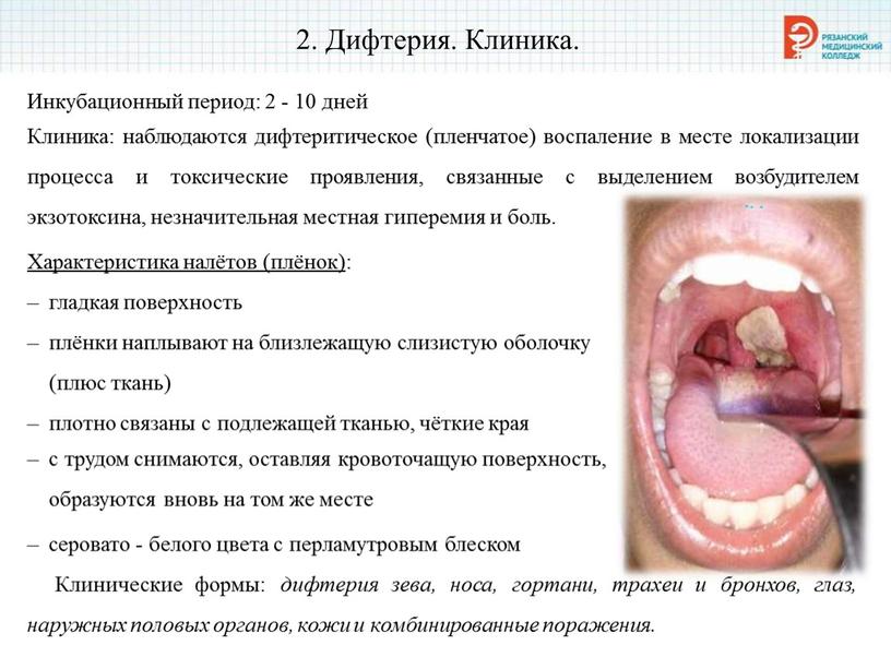 Дифтерия. Клиника. Инкубационный период: 2 - 10 дней