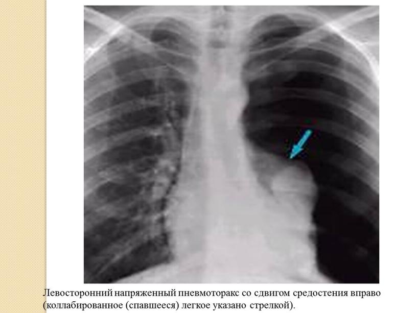 Левосторонний напряженный пневмоторакс со сдвигом средостения вправо (коллабированное (спавшееся) легкое указано стрелкой)