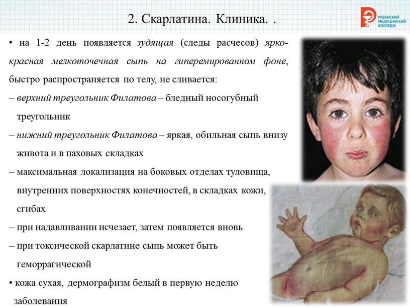 Скарлатина. Клиника. . • на 1-2 день появляется зудящая (следы расчесов) ярко-красная мелкоточечная сыпь на гиперемированном фоне , быстро распространяется по телу, не сливается: –…