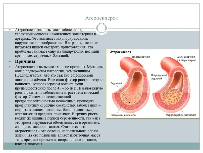 Атеросклероз Атеросклерозом называют заболевание, характеризующееся накоплением холестерина в артериях