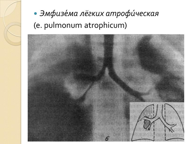 Эмфизе́ма лёгких атрофи́ческая (е