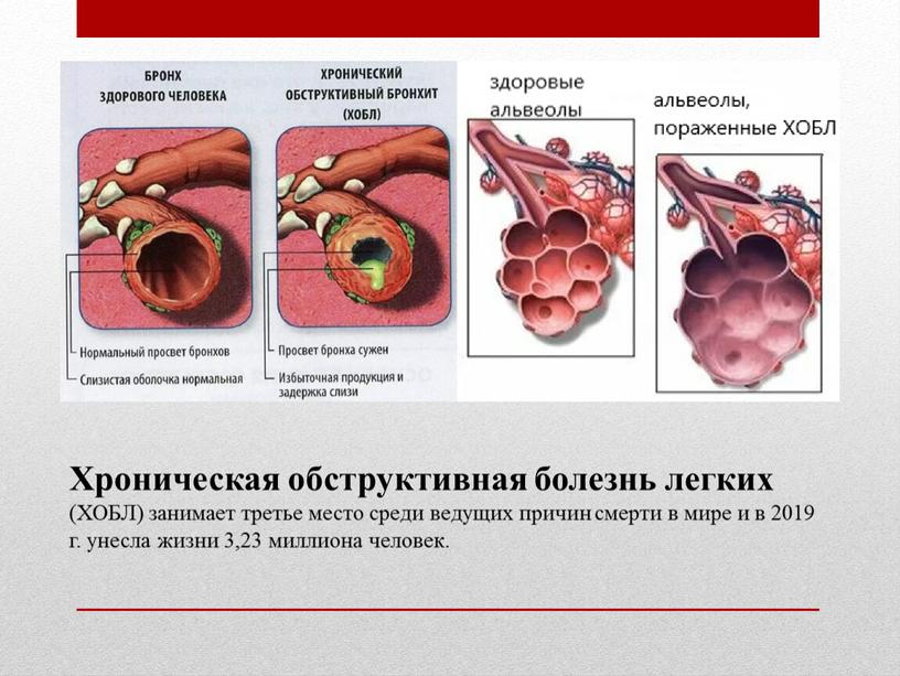 Хроническая обструктивная болезнь легких (ХОБЛ) занимает третье место среди ведущих причин смерти в мире и в 2019 г