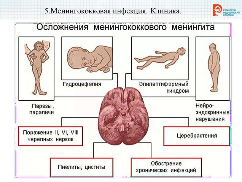 Менингококковая инфекция. Клиника