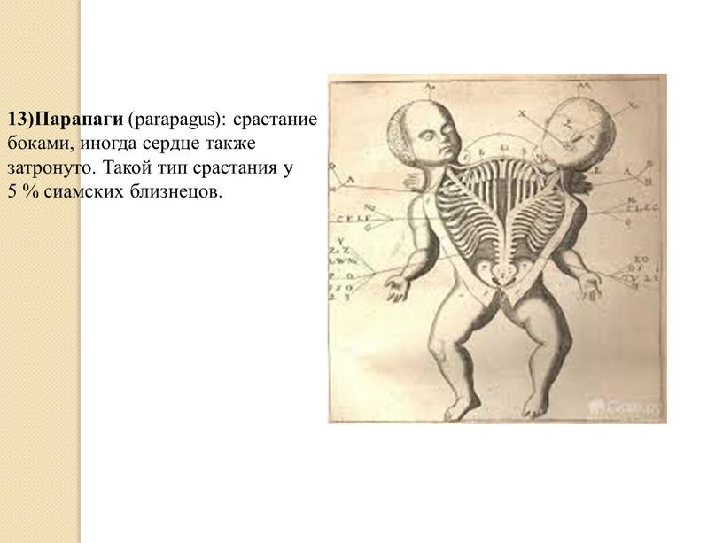 Парапаги (parapagus): срастание боками, иногда сердце также затронуто