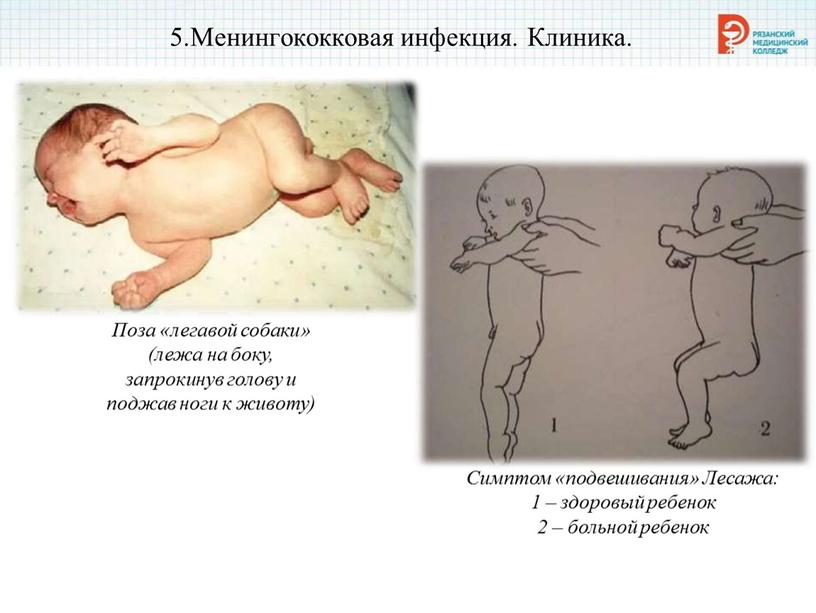 Менингококковая инфекция. Клиника