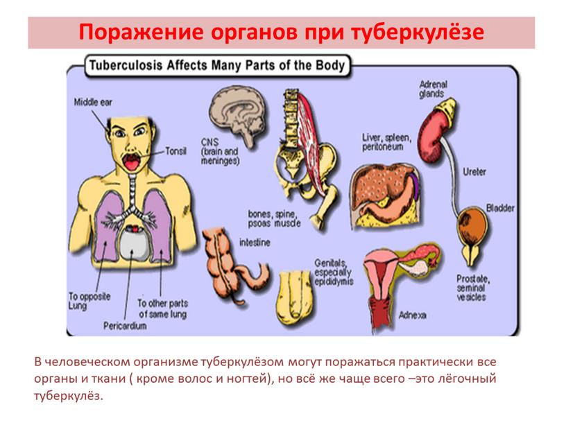 Поражение органов при туберкулёзе