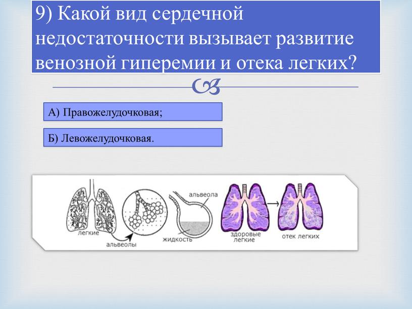 Какой вид сердечной недостаточности вызывает развитие венозной гиперемии и отека легких?