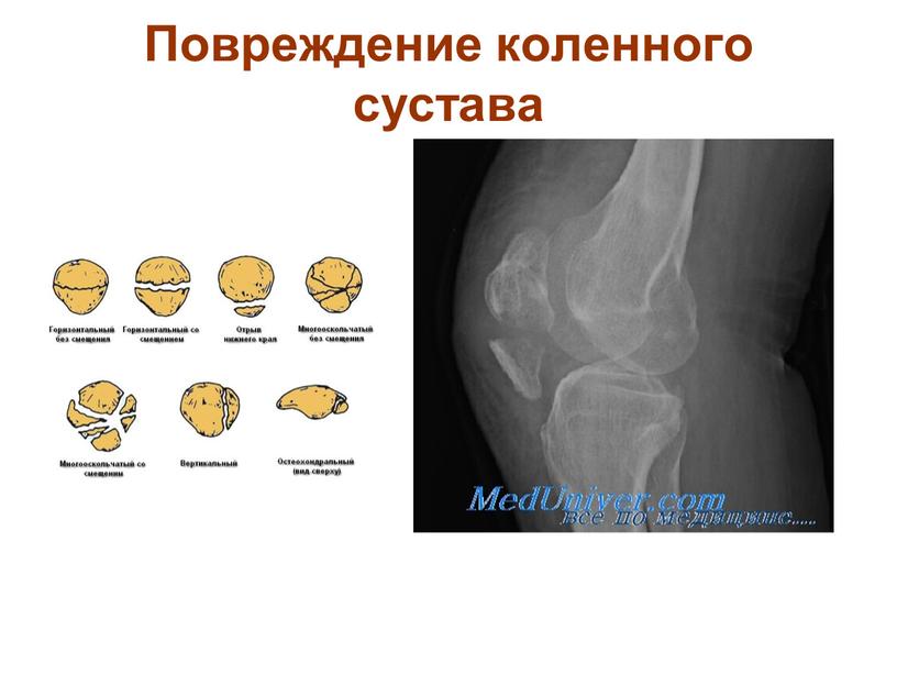 Повреждение коленного сустава