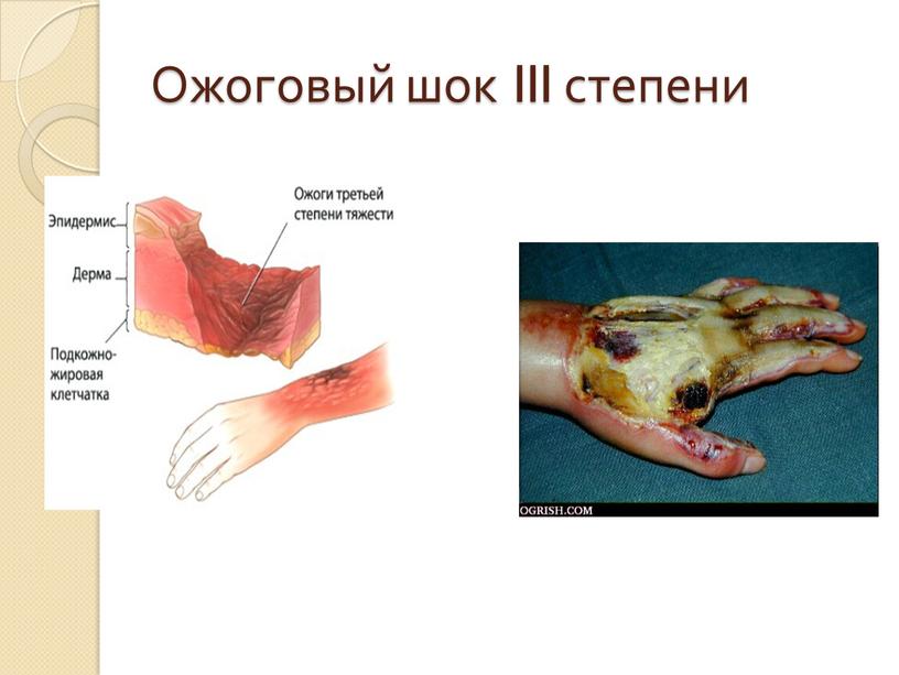 Ожоговый шок III степени