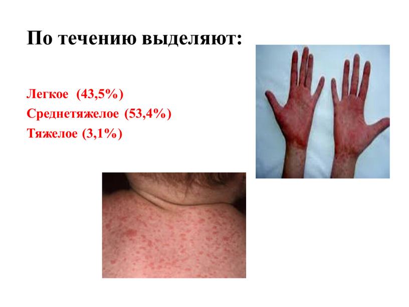 По течению выделяют: Легкое (43,5%)