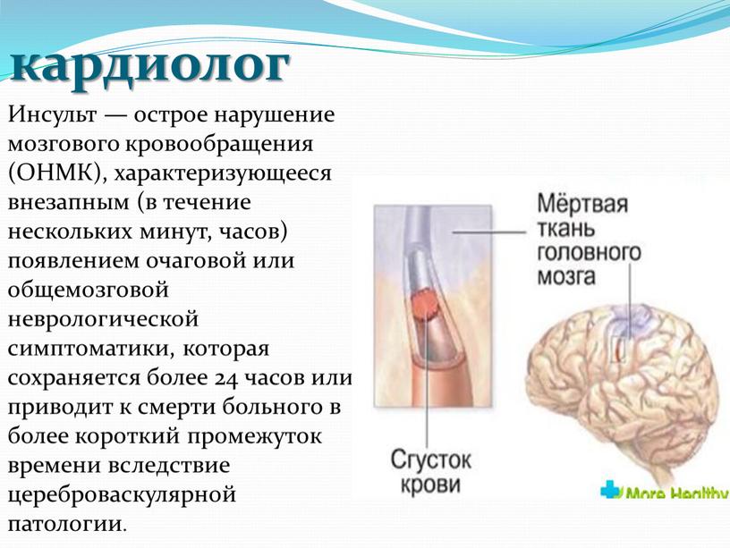 Инсульт — острое нарушение мозгового кровообращения (ОНМК), характеризующееся внезапным (в течение нескольких минут, часов) появлением очаговой или общемозговой неврологической симптоматики, которая сохраняется более 24 часов…