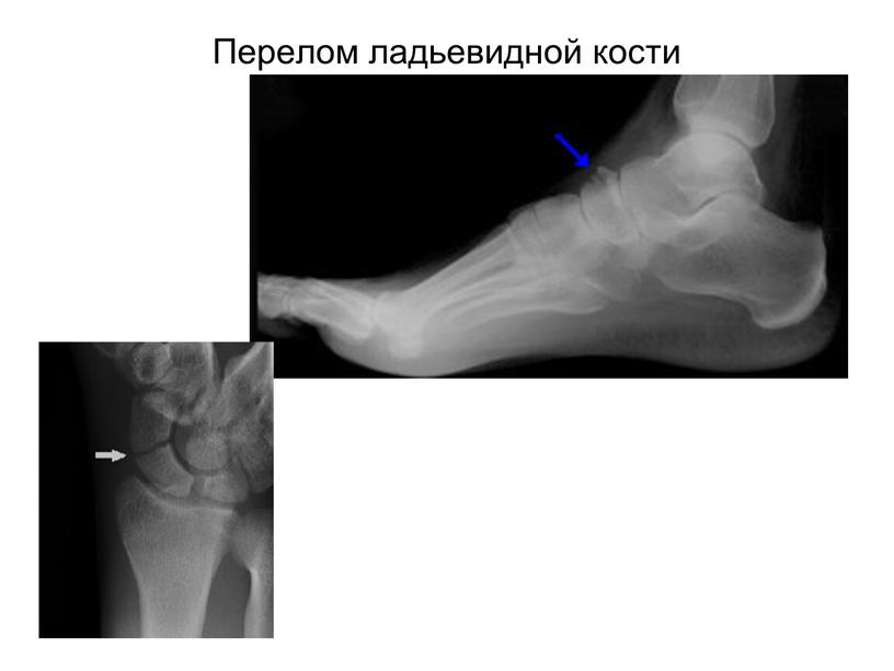 Перелом ладьевидной кости