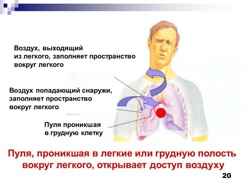 Пуля, проникшая в легкие или грудную полость вокруг легкого, открывает доступ воздуху