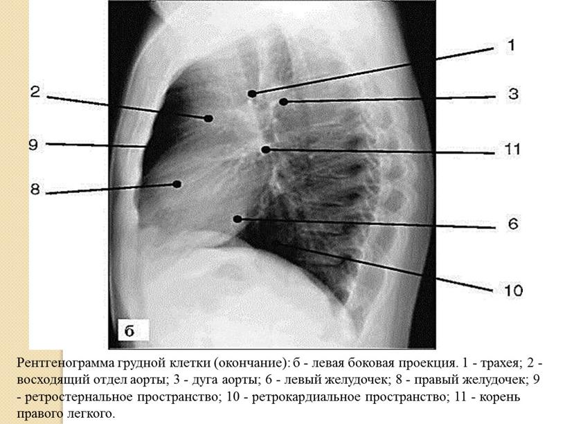 Рентгенограмма грудной клетки (окончание): б - левая боковая проекция