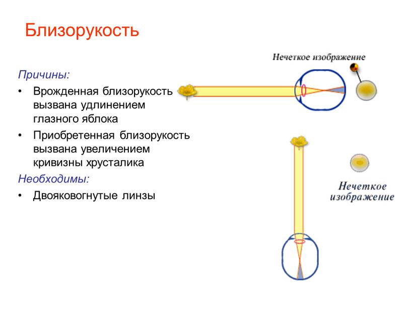 Близорукость Причины: Врожденная близорукость вызвана удлинением глазного яблока