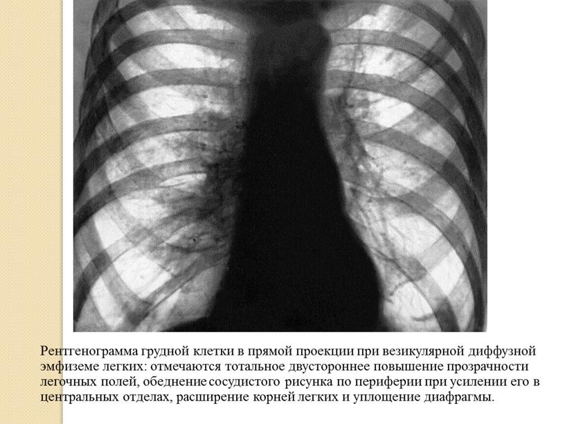 Рентгенограмма грудной клетки в прямой проекции при везикулярной диффузной эмфиземе легких: отмечаются тотальное двустороннее повышение прозрачности легочных полей, обеднение сосудистого рисунка по периферии при усилении…