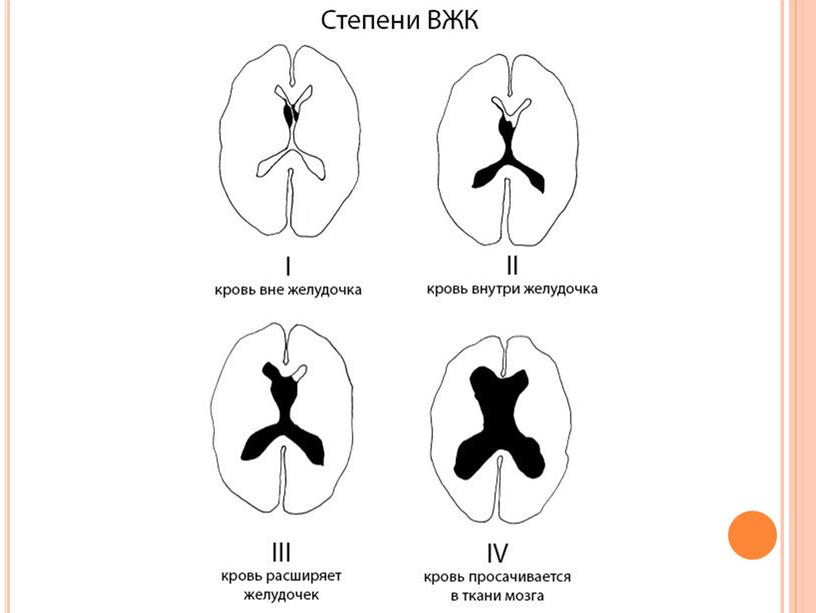 Внутрижелудочковое кровоизлияние (ВЖК) у новорожденных