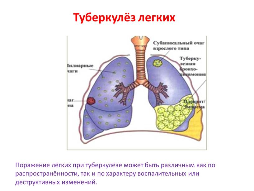 Туберкулёз легких Поражение лёгких при туберкулёзе может быть различным как по распространённости, так и по характеру воспалительных или деструктивных изменений