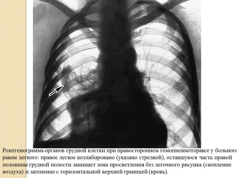 Рентгенограмма органов грудной клетки при правостороннем гемопневмотораксе у больного раком легкого: правое легкое коллабировано (указано стрелкой), оставшуюся часть правой половины грудной полости занимает зона просветления…