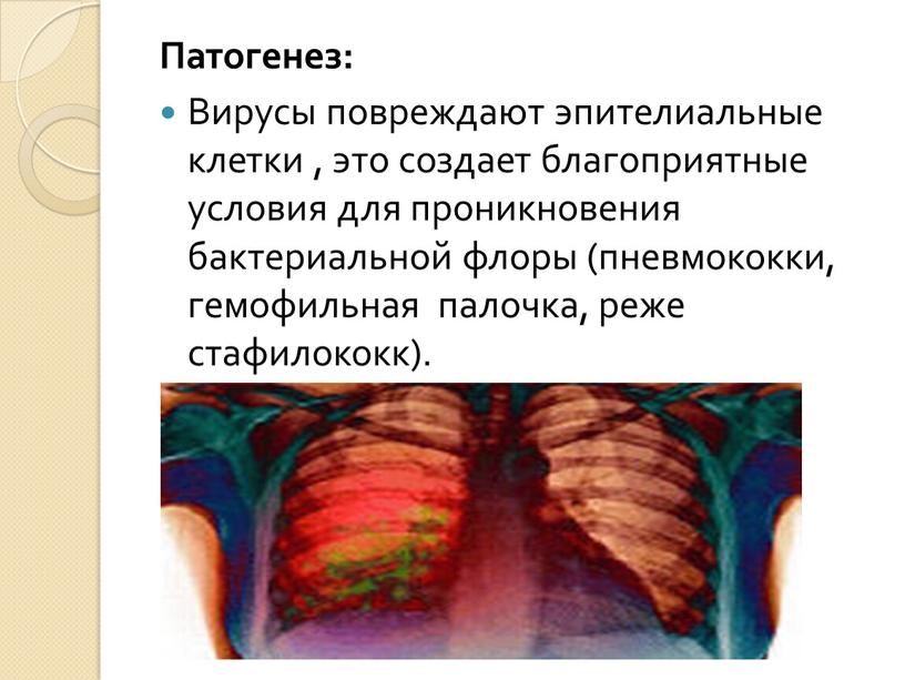 Патогенез: Вирусы повреждают эпителиальные клетки , это создает благоприятные условия для проникновения бактериальной флоры (пневмококки, гемофильная палочка, реже стафилококк)