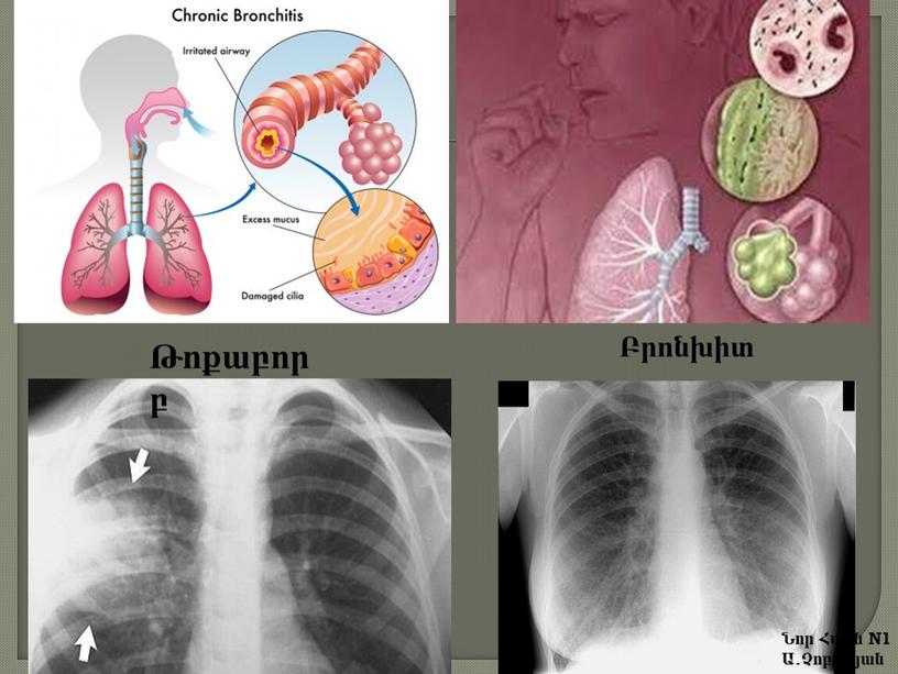Բրոնխիտ Թոքաբորբ Նոր Հաճն N1 Ա.Չոբանյան