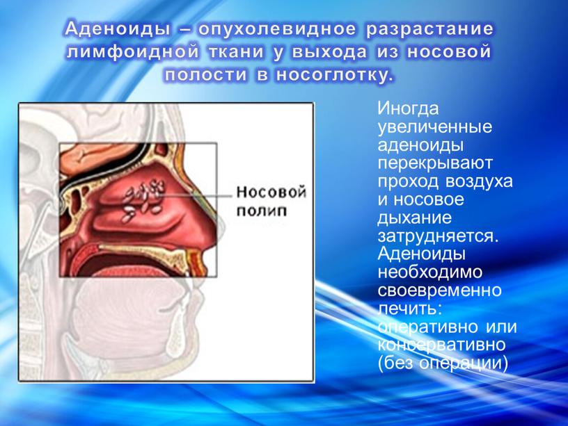 Иногда увеличенные аденоиды перекрывают проход воздуха и носовое дыхание затрудняется