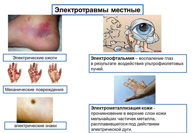 Электротравмы местные Электрические ожоги электрические знаки