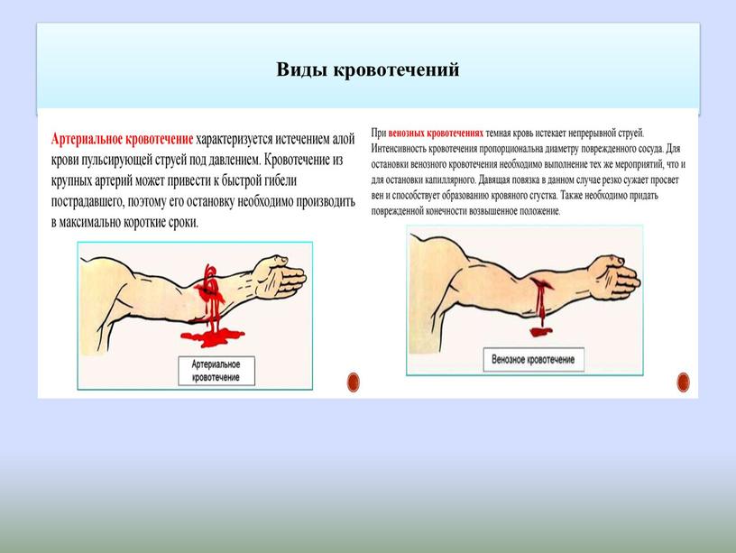 Виды кровотечений