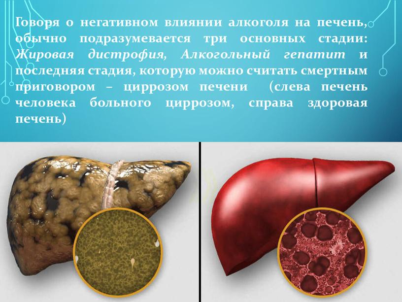 Говоря о негативном влиянии алкоголя на печень, обычно подразумевается три основных стадии: