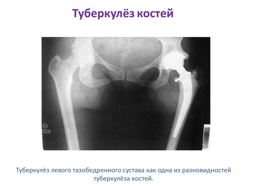 Туберкулёз костей Туберкулёз левого тазобедренного сустава как одна из разновидностей туберкулёза костей