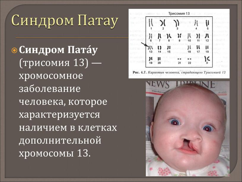 Синдром Патау Синдром Пата́у (трисомия 13) — хромосомное заболевание человека, которое характеризуется наличием в клетках дополнительной хромосомы 13