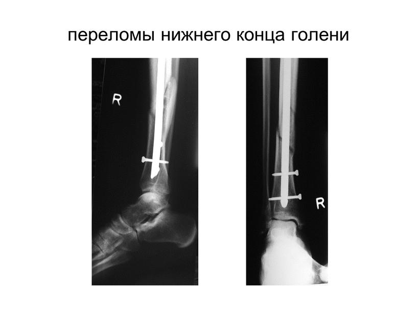 переломы нижнего конца голени