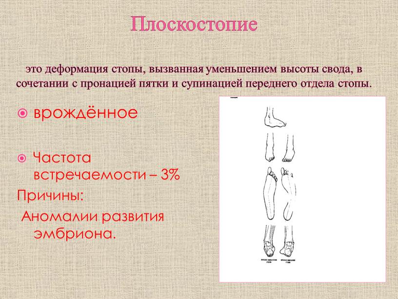 Плоскостопие это деформация стопы, вызванная уменьшением высоты свода, в сочетании с пронацией пятки и супинацией переднего отдела стопы