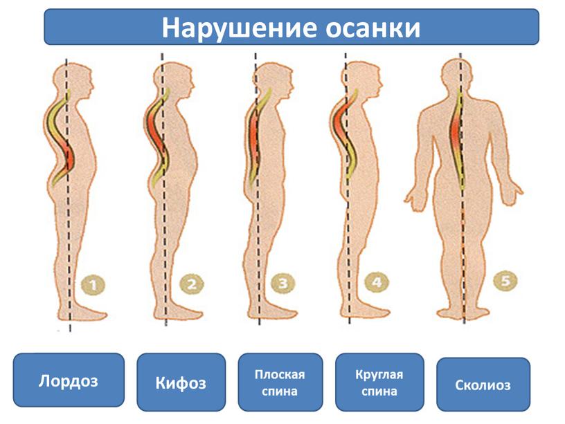 Лордоз Кифоз Плоская спина Круглая спина