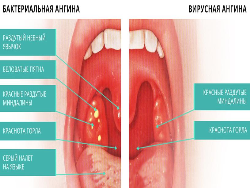 Презентация к занятию по внеурочной деятельности« Ангина»