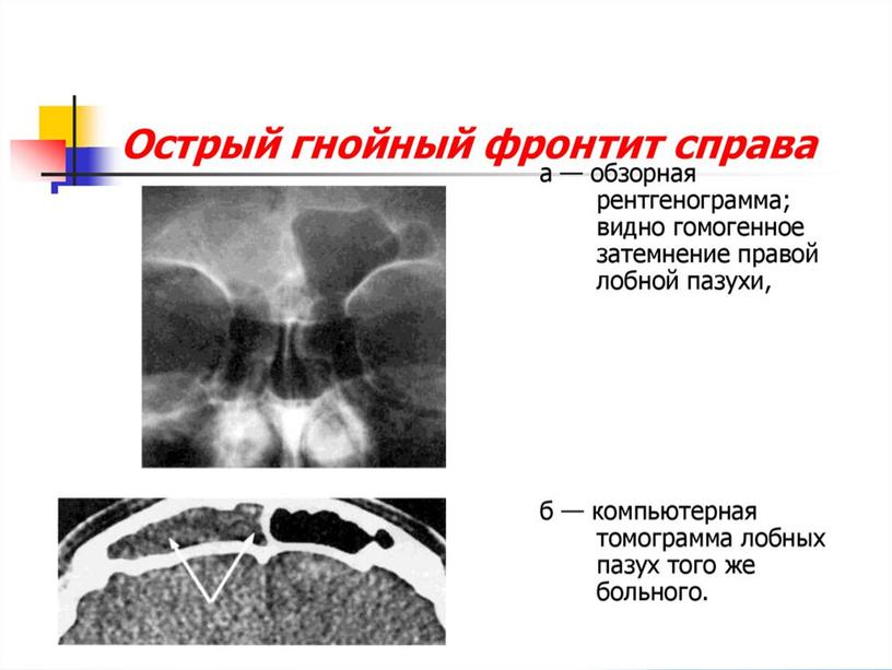 Фронтит. Причины, симптомы, виды и лечение фронтита.