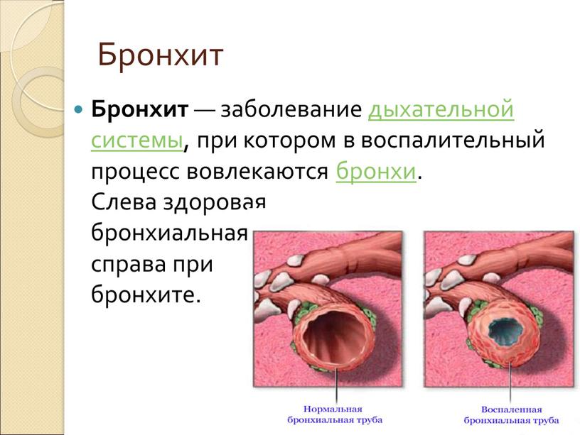 Бронхит Бронхит — заболевание дыхательной системы, при котором в воспалительный процесс вовлекаются бронхи