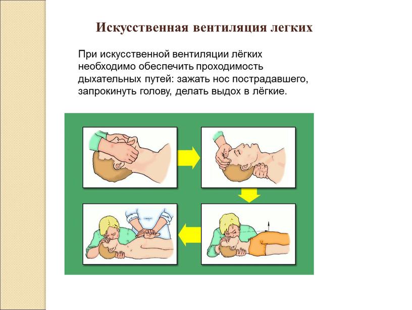 Искусственная вентиляция легких