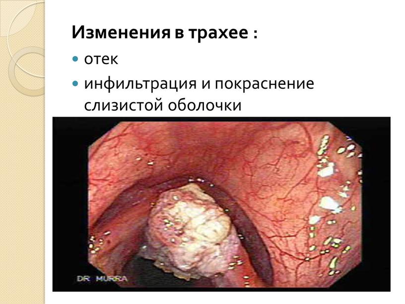 Изменения в трахее : отек инфильтрация и покраснение слизистой оболочки