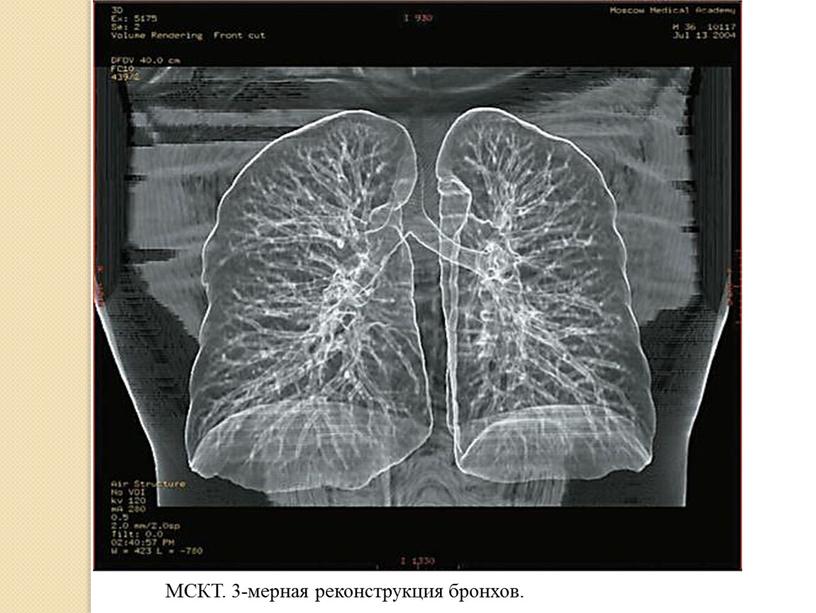 МСКТ. 3-мерная реконструкция бронхов