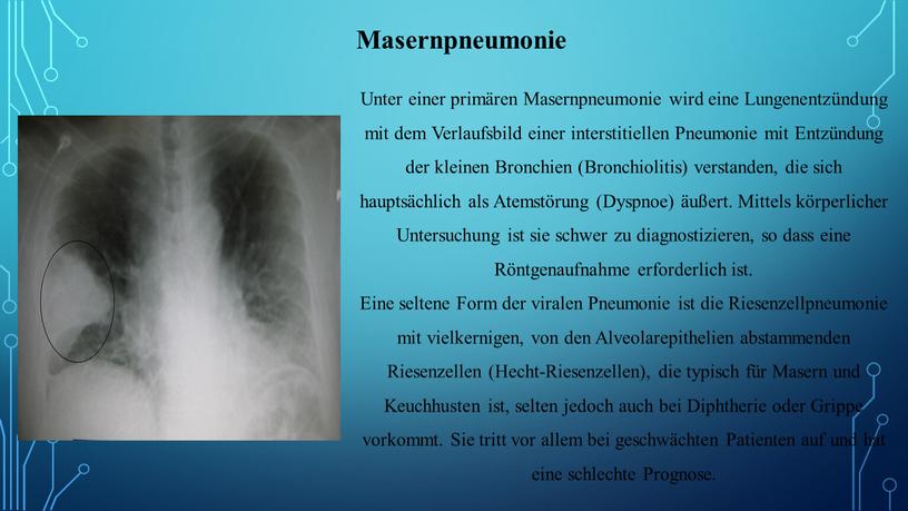Masernpneumonie Unter einer primären