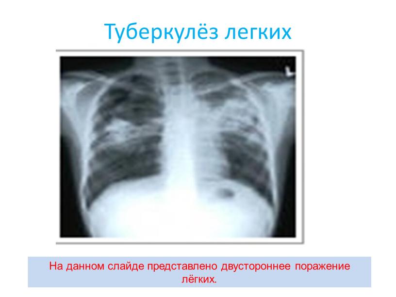 Туберкулёз легких На данном слайде представлено двустороннее поражение лёгких