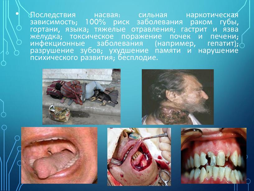 Последствия насвая: сильная наркотическая зависимость; 100% риск заболевания раком губы, гортани, языка; тяжелые отравления; гастрит и язва желудка; токсическое поражение почек и печени; инфекционные заболевания…