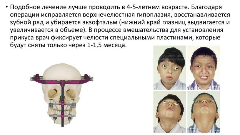 Презентация по анатомии и физиологии человека: Синдром Крузона.
