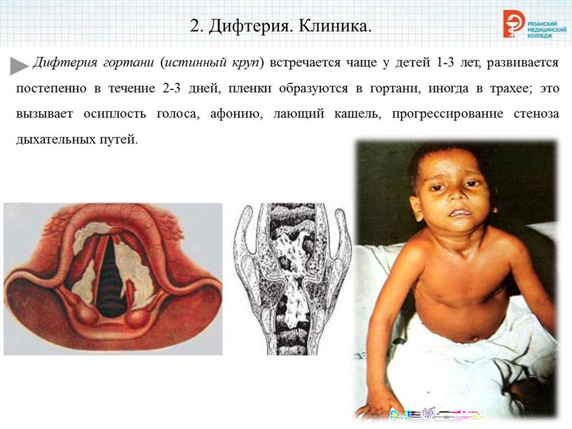 Дифтерия. Клиника. Дифтерия гортани ( истинный круп ) встречается чаще у детей 1-3 лет, развивается постепенно в течение 2-3 дней, пленки образуются в гортани, иногда…