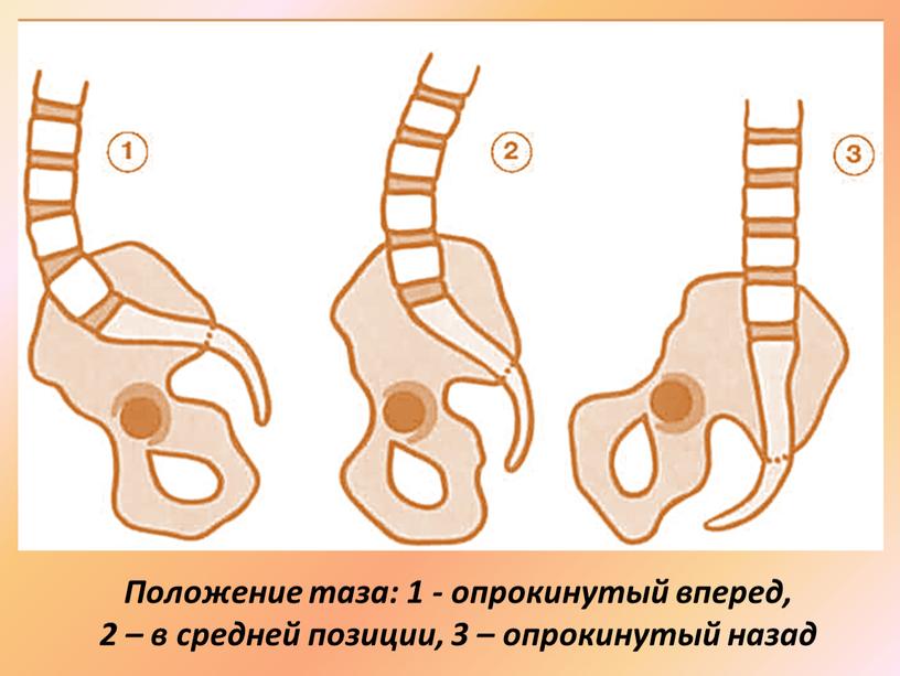 Положение таза: 1 - опрокинутый вперед, 2 – в средней позиции, 3 – опрокинутый назад
