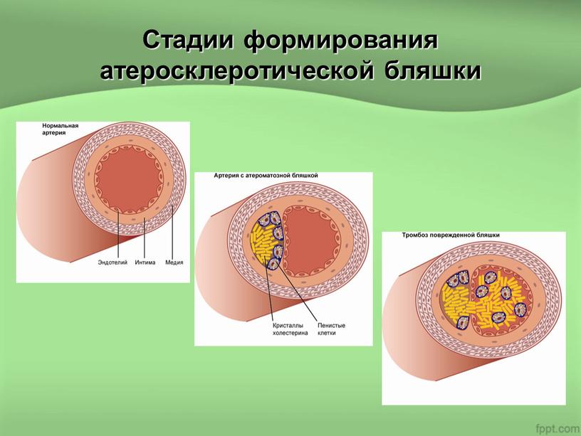 Стадии формирования атеросклеротической бляшки